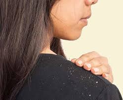 Coconut oil & lemon massage coconut oil nourishes your hair, while lemon juice helps black tea is another effective ingredient which can help prevent grey hair. Fight Dandruff With These Amazing Remedies And Boost Hair Health
