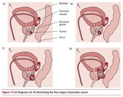 Blood in the urine or semen. Prostate Cancer Treatment Signs Symptoms And Staging