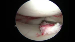 Walking is a excellent way to loosen your knee joint and your therapist can also evaluate the way you walk to observe any issues that may contribute to a torn meniscus. Radial Meniscus Tear Repair Dr Justin Saliman Youtube