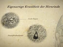 Eventually, alzheimer's disease affects most areas of your brain. Alois Alzheimer Und Die Entdeckung Der Krankheit Alzheimer Forschung Initiative E V Afi