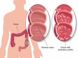 When you have ulcerative colitis (uc), your large intestine can have a hard time absorbing water and salt. Ulcerative Colitis Foods That Make Uc Worse University Health News