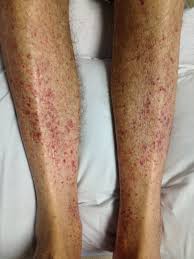 I thought nothing of it since i was on omnicef at the time and thought it was a reaction. Basics Of Dermatology 1 Maimonides Emergency Medicine Residency