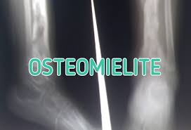 osteomielite home facebook