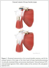 These tendinous insertions along with the articular capsule subscapular bursa is located between the subscapularis tendon and the scapula. An Unusual Variant Of The Origin Of The Short Head Of Biceps Brachii