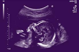 Early pregnancy dating scans remain free of charge for all new zealand residents. Womans Ultrasound Services Wellington Obstetrics