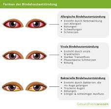 Eine virale bindehautentzündung entsteht, wenn ein virus eine schwellung und rötung der äußersten schicht des auges (der bindehaut) verursacht. Bindehautentzundung Ursachen Symptome Behandlung