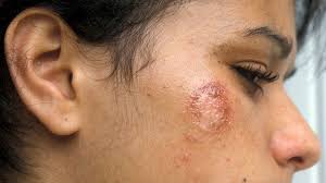 A rash is a reaction in which the skin develops an abnormal texture and other features, such as the most common form of impetigo, known as herpetic impetigo, occurs mostly on the face or limbs and is characterized by Is It Impetigo Or Something Else 8 Distinguishing Factors Everyday Health