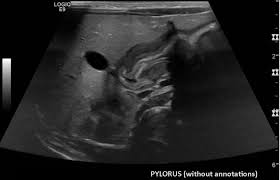 A mode is an operational state that a system has been switched to. Hypertrophic Pyloric Stenosis Radiology Case Radiopaedia Org