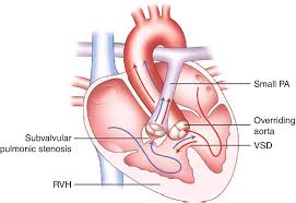 Tetralogy of fallot (tof) is a congenital heart defect which is classically understood to involve four anatomical abnormalities of the heart (although only three of them are always present). Tetralogy Of Fallot Springerlink