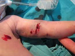 Although the skin is broken. Gunshot Wound Of The Fetus Springerlink