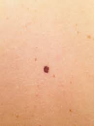 Read on to learn about identifying cancerous moles from benign marks. Signs Of Skin Cancer This Skin Check Can Save Your Life Glamour