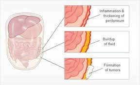 We did not find results for: Peritoneal Mesothelioma Explained Asbestos Justice