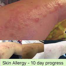 Natural And Safe Way To Treat Skin Allergy Skin Allergy Treat Skin Allergies