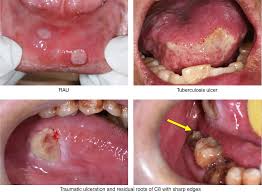 Image result for mouth ulcer on tongue)