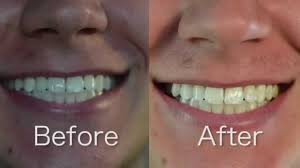 Find deals on products in oral care on amazon. Crest 3d White Whitestrips 1 Hr Express Review And Before After Youtube