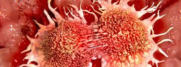 Symptoms of lung cancer at stage 4. Cancer Quiz Faqs Frequently Asked Questions Rxlist