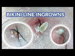 While hairs typically grow up and out of your body, sometimes they can curl around and grow back ingrown toenails. Pin On The Most Satisfying Things