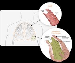 Pathophysiology Bronchiectasis