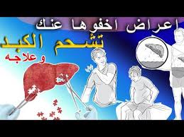 تشحم الكبد أعراض لن تتوقعها تراكم الدهون الوقاية والعلاج Youtube Sic
