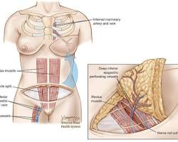 Image of Breast reconstruction with autologous tissue