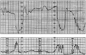 Intrapartum Fetal Assessment Obstetrics Medbullets Step 2 3