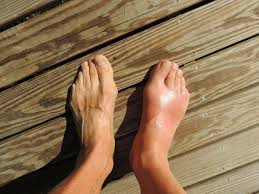 Here you can find a guide on how to treat a turf toe. Turf Toe Archives Washington Orthopaedic Center