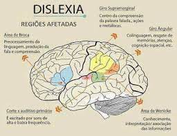 O que é, causas e sintomas. Rede Amor A Vida O Que E Dislexia E Uma A Perturbacao Na Aprendizagem Da Leitura Pela Dificuldade No Reconhecimento Da Correspondencia Entre Os Simbolos Graficos E Os Fonemas Bem Como