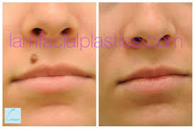 This Young Lady Had A Mole Removed From Her Upper Lip And Is Shown Before And Six Months After Her Procedure Molere Facial Plastic Mole Removal How To Remove