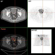 What are the symptoms of bladder cancer in men? Bladder Cancer Wikipedia