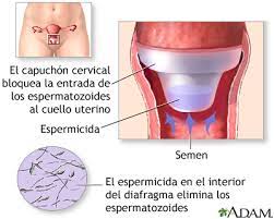 Metodos Anticonceptivos De Barrera Serie Capuchon Cervical Medlineplus Enciclopedia Medica