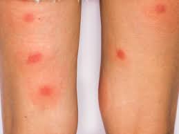 Ticks can carry lyme disease , and their bite leaves a rash that. How To Tell Spiders Vs Bed Bugs