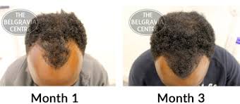 I can't believe how beautiful it looks now. Do Belgravia S Hair Loss Treatments Work As Well For Afro Hair