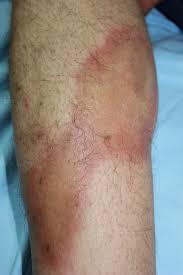 Image result for Lipodermatosclerosis