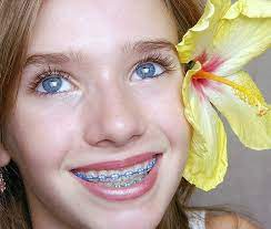 Braces Color Matches With Eye Color Too Cute Braces Colors Teeth Braces Cute Braces