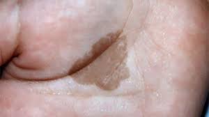 Image result for brown patches on the feet
