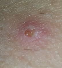 These hairs then form a bump in the skin which may be itchy or painful and can easily become infected. in some cases, an infected ingrown hair can even require. Infected Ingrown Hairs Or Herpes Sexual Health Forums Patient