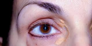 Image result for xantelasma