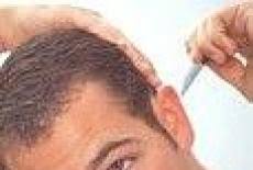 O singura parte sau o portiune a unui membru este afectata. Zona Zoster Cauze Simptome Tratament