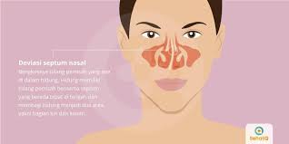Hidung pak cao selalu mengeluarkan darah dalam sepuluh meski begitu, pria dari hezhou, china, itu tidak tahu apa yang menyebabkan hidungnya mimisan. Deviasi Septum Nasal Tanda Dan Gejala Penyebab Cara Mengobati Cara Mencegah