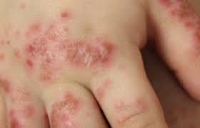 Image result for Eczema nummulare