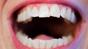 It can significantly affect your oral health if you suffer from dry mouth. I Wake Up With My Mouth Full Of Saliva Since So Many Years I Practo Consult