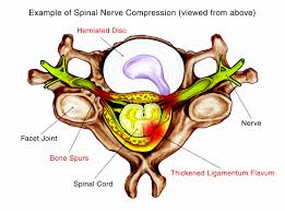 For example, endometriosis is a common condition that may create sporadic, sharp pain in the pelvic area that may radiate to the lower right back. 5 Causes Of Back And Neck Pain Or Discomfort
