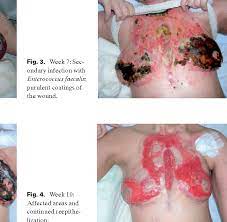 Staphylococcal Scalded Skin Syndrome In An Adult Patient With T Lymphoblastic Non Hodgkin S Lymphoma Semantic Scholar