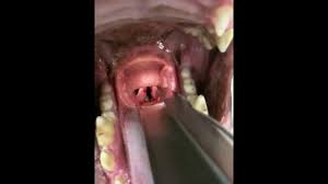 Patients with laryngeal paralysis are at slightly increased risk of anesthetic complications. Laryngeal Paralysis A Veterinarian S Perspective
