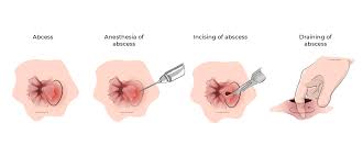 Image result for Perirectal Abscess