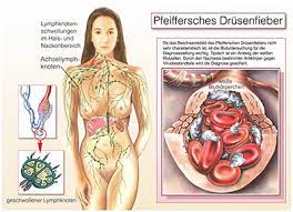 Pfeiffersches Drusenfieber Ursachen Symptome Behandlung Medlexi De