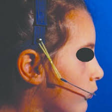 PDF) Comparisons of two protocols for early treatment of anterior open bite