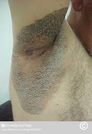 Image result for Erythrasma