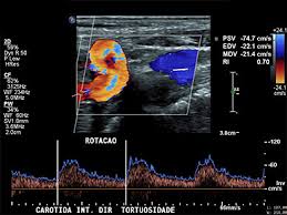 Cada um tem orientações específicas. Ecodoppler Colorido De Carotidas E Arterias Vertebrais Angiovascula