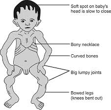 Image result for Craniotabes